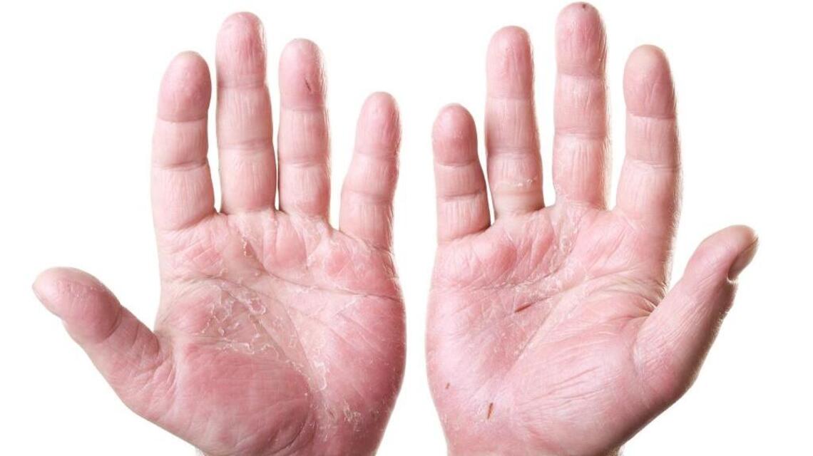 Taking too many antibiotics to treat eczema may worsen your condition