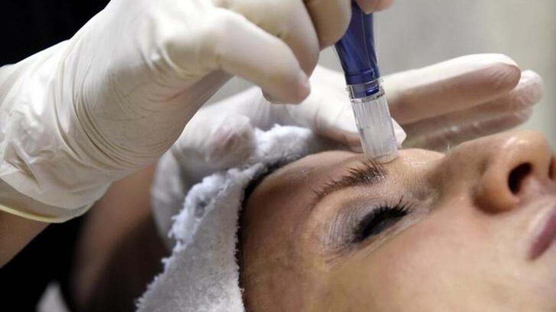 What is microneedling and why is the skin treatment so popular?