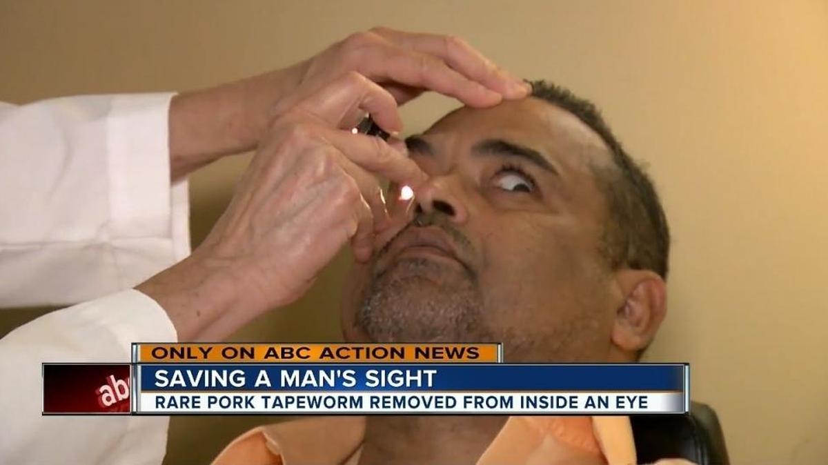 Sam Cordero is examined by Dr. Don Perez at Tampa General Hospital in this screen grab from WFTS. Cordero had a brain-eating parasitic worm living in his left eye that could have gotten there from the consumption of undercooked pork.