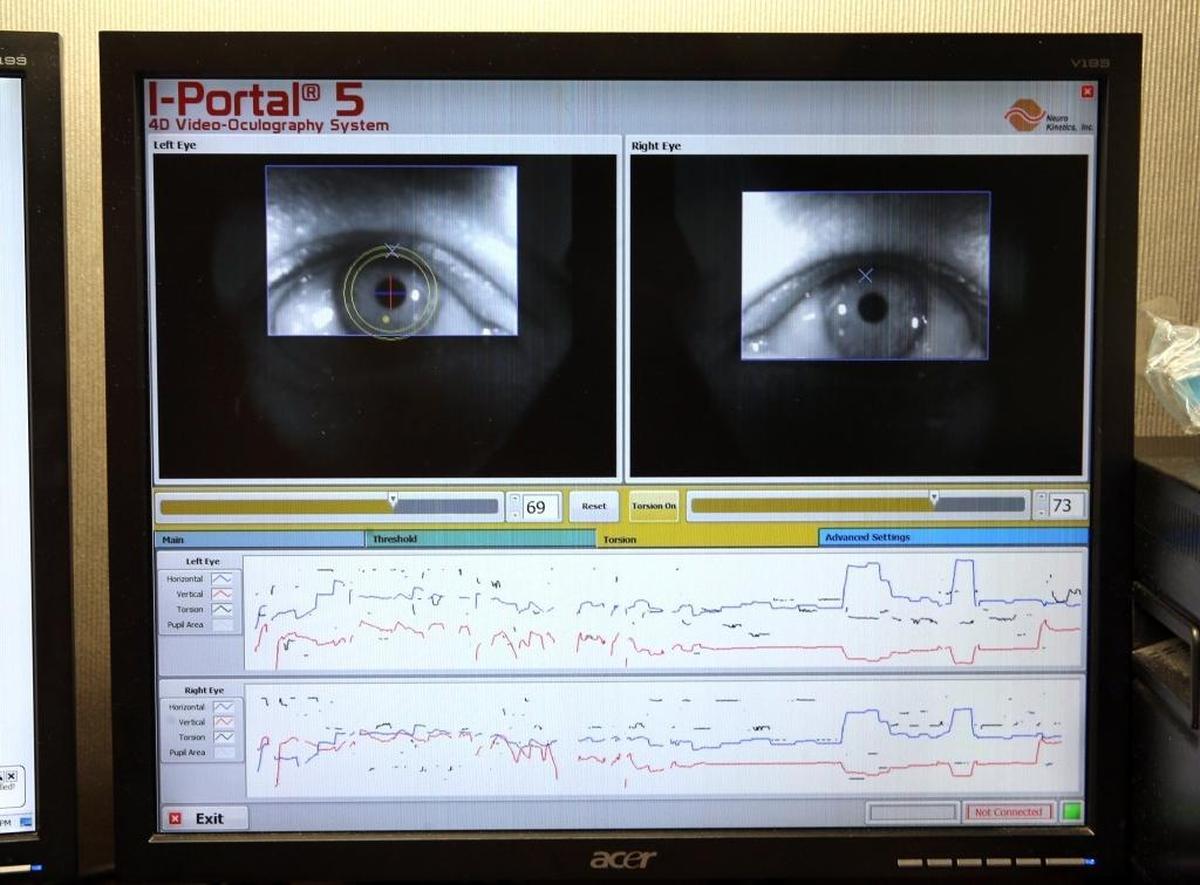 A monitor displays data used to diagnosis concussions. Several hospitals and clinics around Miami are bringing in new techniques and treatments for concussion treatment and diagnosis. At University of Miami Health System, they are using goggles created by Neuro Kinetics that can guide patients through a five minute test that provides a perfect diagnosis 95 percent of the time.