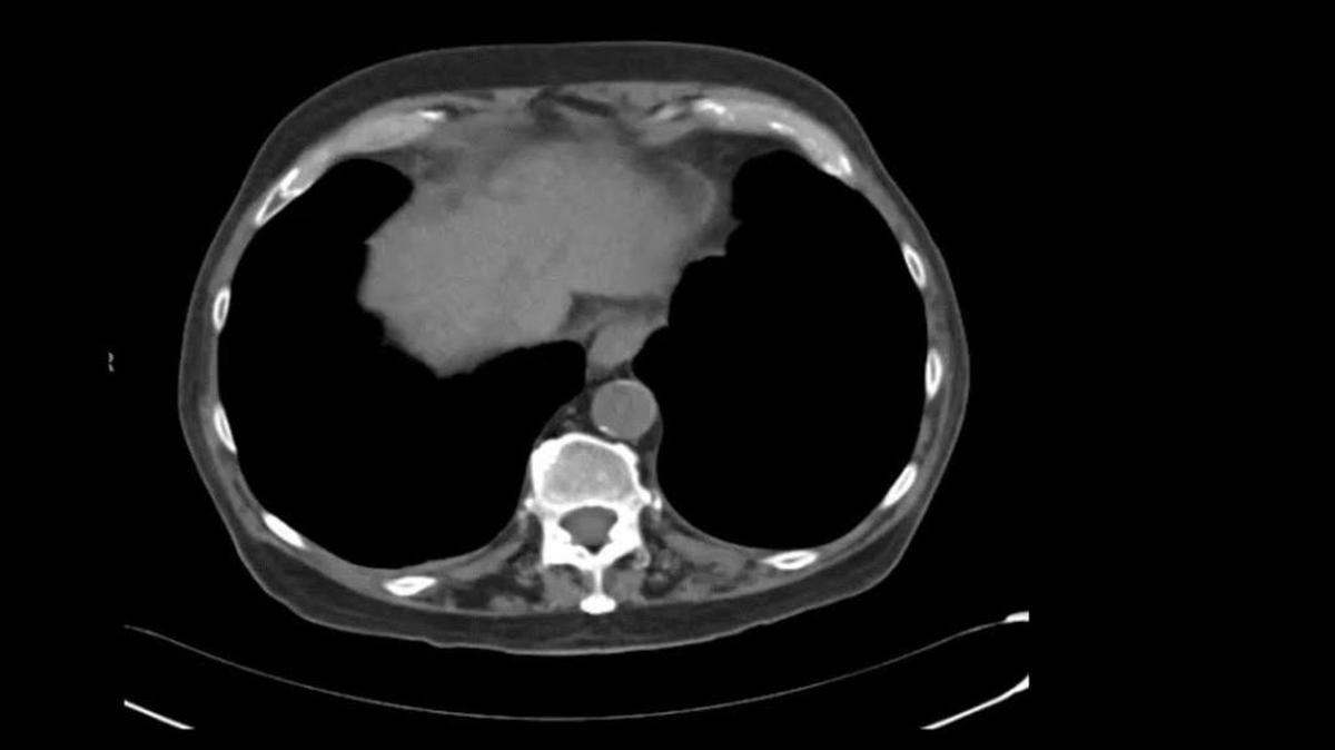 Image from a patient treated with LUMI beads who has live cancer. The illuminated white portions are the beads in the liver tumor.