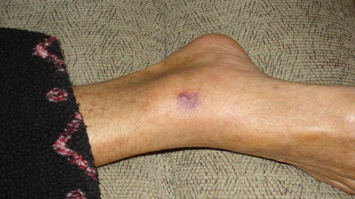 This photo provided by Patty Konietzky shows her husband's foot and what they thought was a bug bite on Sept. 22, 2013, in Ormond Beach, Fla. Patty and her husband, Henry "Butch" Konietzky, went crabbing in the Halifax River near Ormond Beach that month. Butch developed a sore that was later confirmed to be vibrio vulnificus. The bacteria spread quickly in his body and he died 60 hours later.
