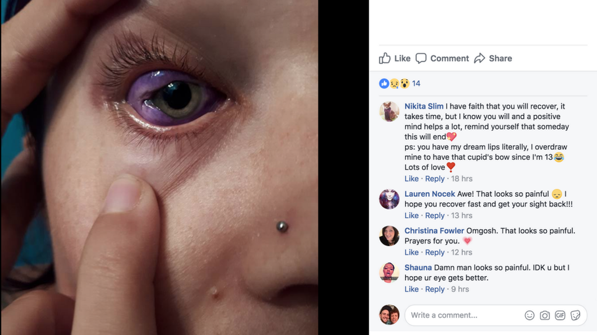 A screenshot of Catt Gallinger's botched purple eye tattoo. (Gallinger/Facebook)