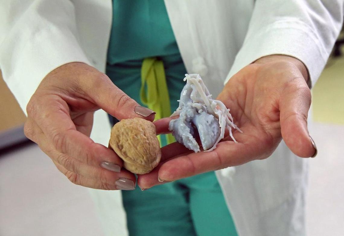 Dr. Kristine Guleserian, a cardiovascular surgeon for Nicklaus Children’s Hospital, holds a three-dimensional plastic model of Liam Javi Nieves’s next to a walnut. Doctors at Nicklaus Children’s performed a total of 20 hours of surgery on three infants evacuated from Puerto Rico to Miami for heart operations after Hurricane Maria left most of the island’s hospitals unable to render care.