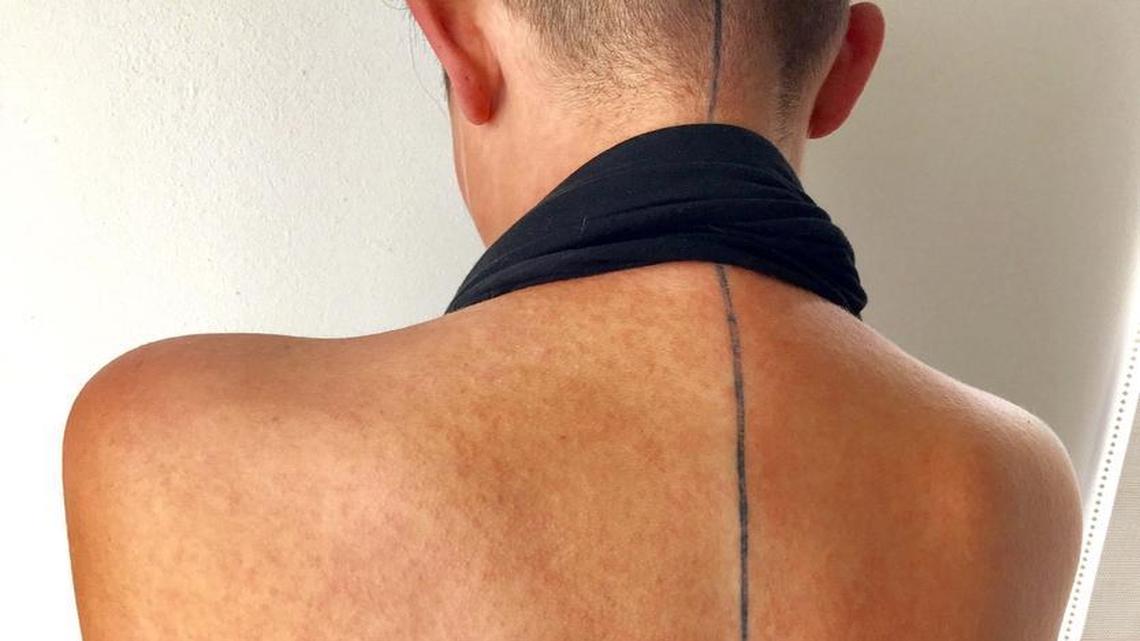 Lou Dickinson, 36, of Miami shows a rash that spread across her body and which she suspects was caused by Zika virus infection. Dickinson, who said she also had a fever, muscle pain and red eyes, had difficulty getting a Zika test.