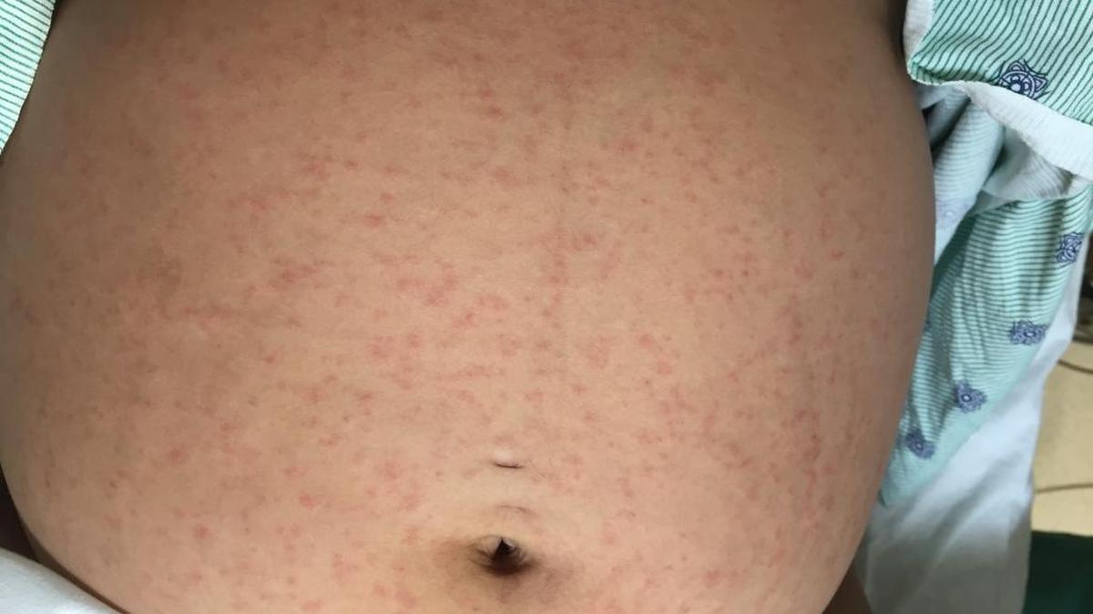 This pregnant woman developed a rash after contracting the Zika virus. Physicians from the University of Miami Health System treated her and wrote a case study about her rash in the New England Journal of Medicine. She eventually delivered a full-term infant, who tested negative for Zika.