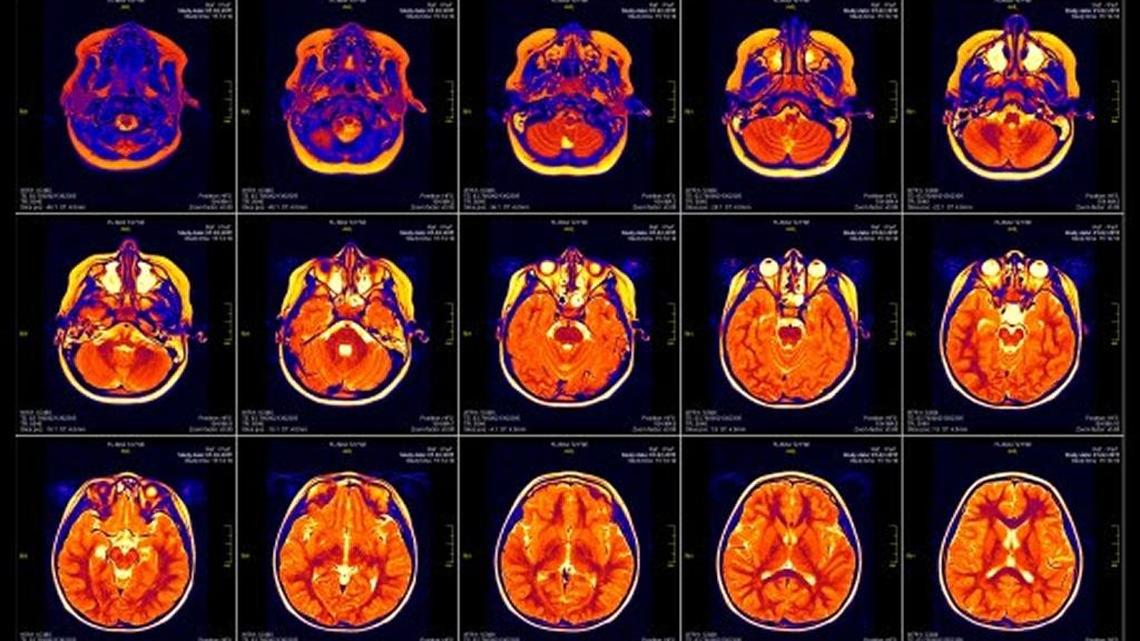 
As part of the Adolescent Brain Cognitive Development Study, researchers will using neuro-imaging to track the impact of drug use on adolescent brain development. Pictured here is a brain MRI slide of a girl. Actual patient and clinic names have been omitted.
