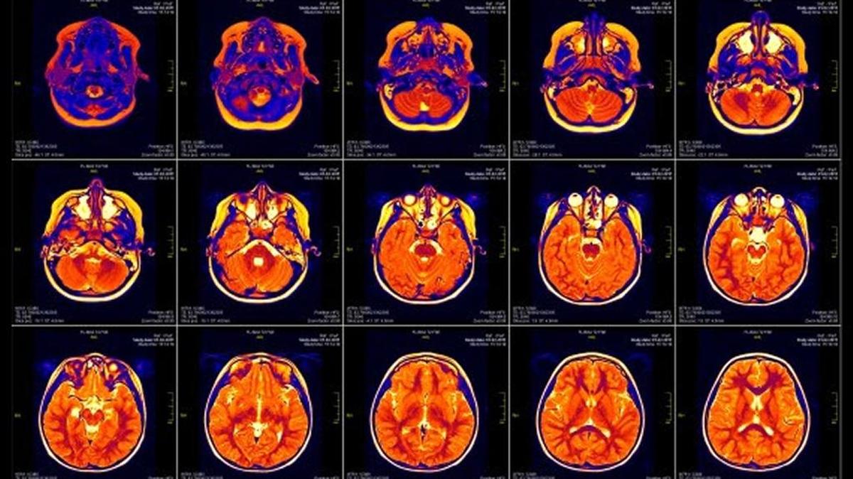 
As part of the Adolescent Brain Cognitive Development Study, researchers will using neuro-imaging to track the impact of drug use on adolescent brain development. Pictured here is a brain MRI slide of a girl. Actual patient and clinic names have been omitted.
