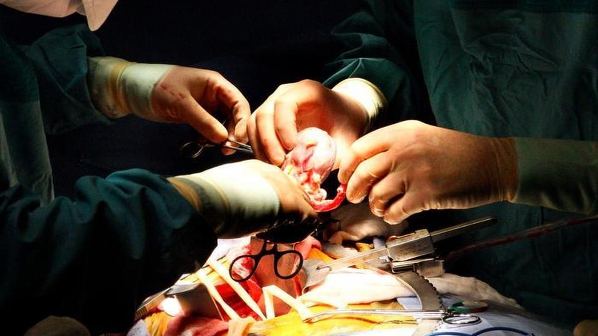 In this photo from July 2008, surgeons remove a kidney from a live donor patient at the Miami Transplant Institute, a joint program between the University of Miami Miller School of Medicine and Jackson Memorial Hospital. The Life Alliance Organ Recovery Agency is the only group federally licensed to procure and distribute organs for transplant in South Florida.