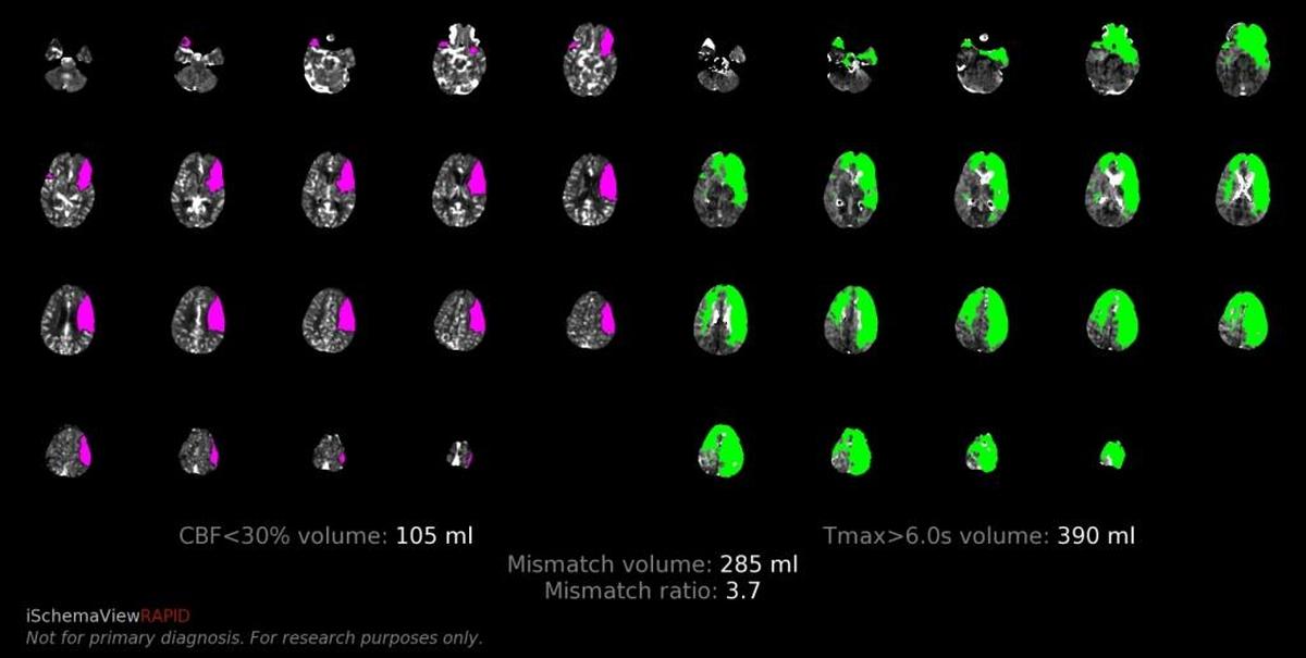 CT scans of a patient’s brain after suffering an ischemic stroke show dead brain tissue shaded in pink on the left. The areas shaded in green represent damaged brain tissue that can be saved by surgically removing the clot causing the stroke and restoring blood flow to those areas of the brain.