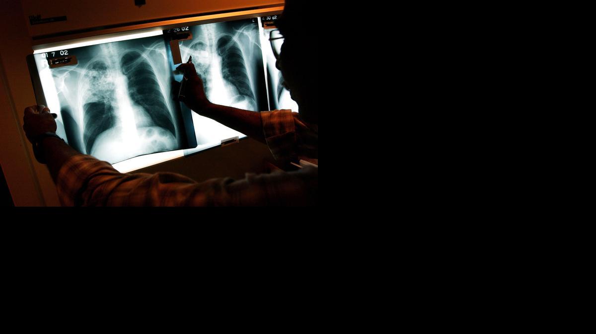 
A doctor examines the x-rays of a tuberculosis patient at a clinic in Brooklyn, New York.
