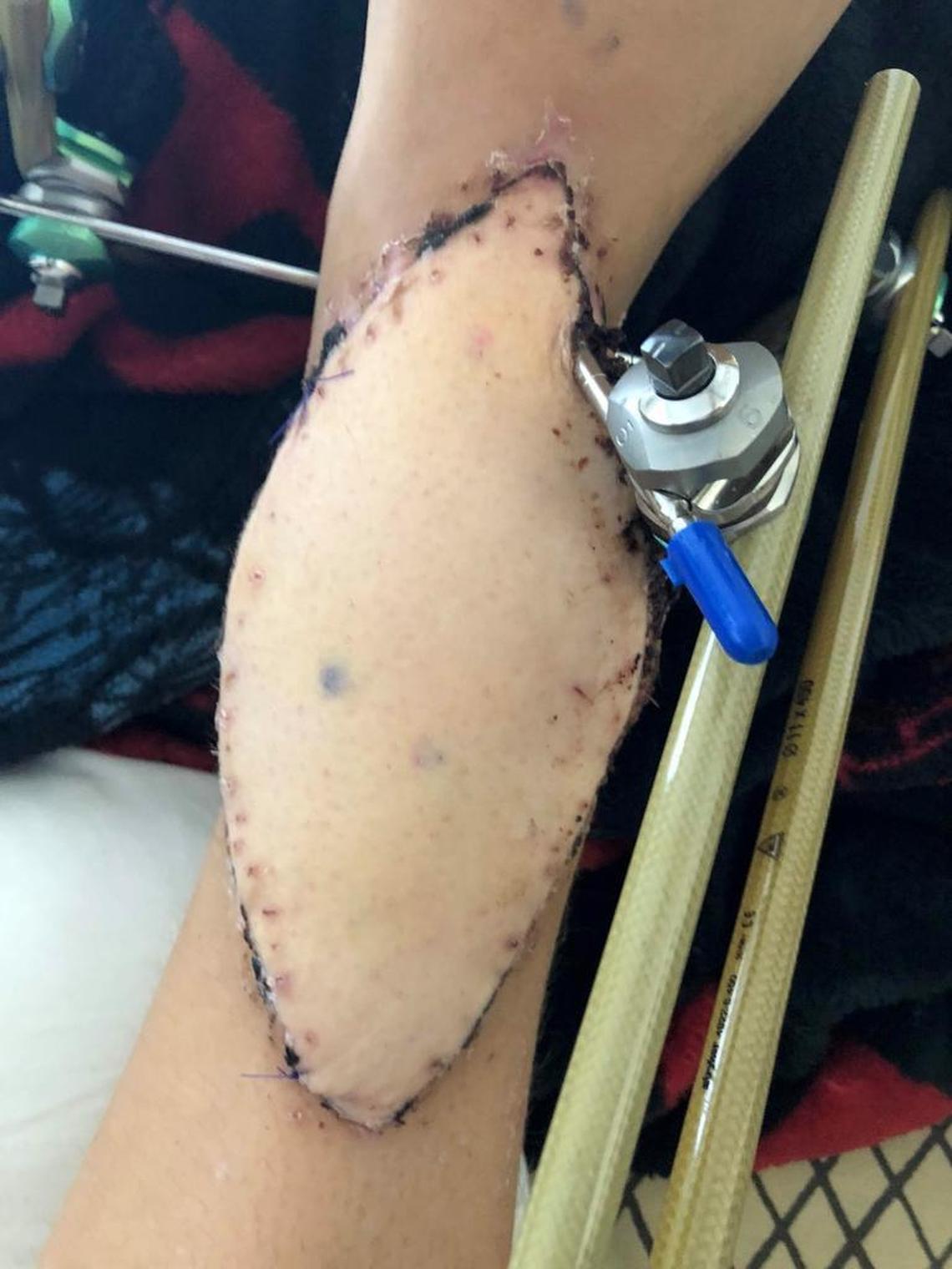 The football-shaped, half a foot long flap of skin that now covers Kyle Laman’s right ankle.