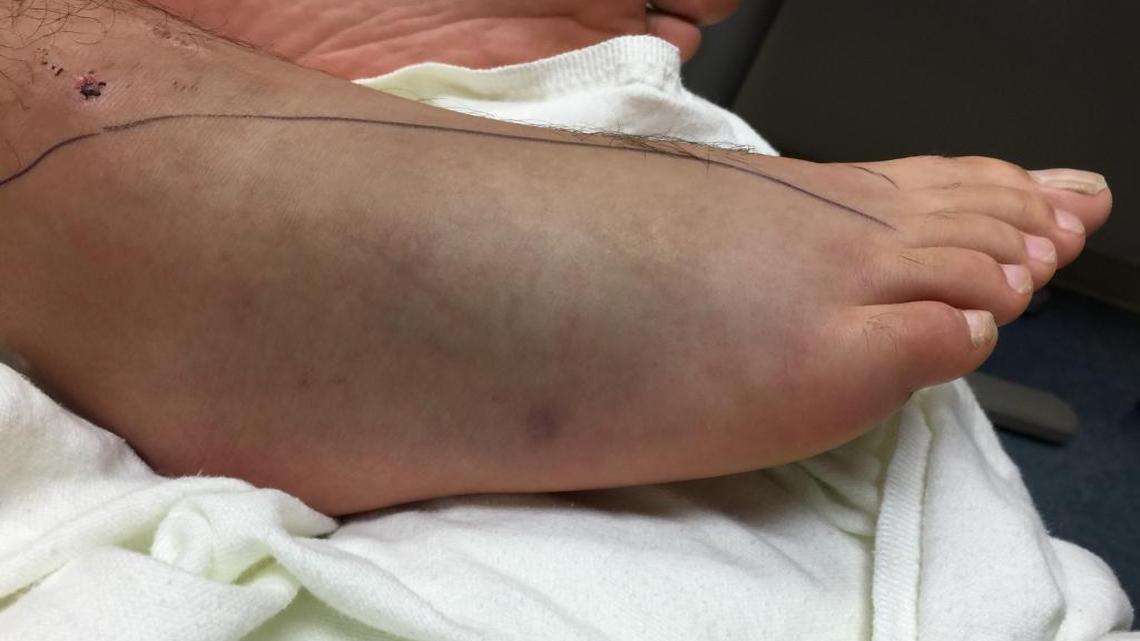 Jordan Cueto, 17, was bitten on his foot by a Water Mocassin. Miami-Dade Fire Rescue’s Venom One team delivered anti-venom.