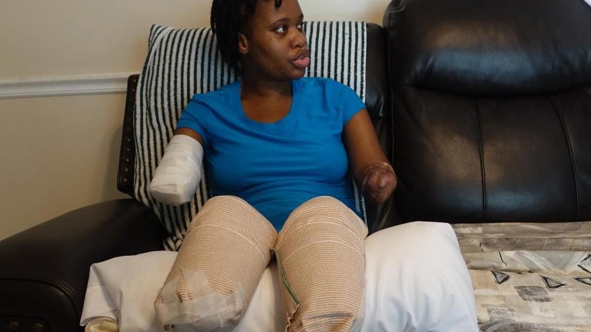 Kayleigh Ferguson-Walker, who lost her limbs because of a sepsis infection, talks with physical therapist John Quakenbush on Tuesday, Aug. 22, 2017, at her mother’s house in Coral Springs, Fla.