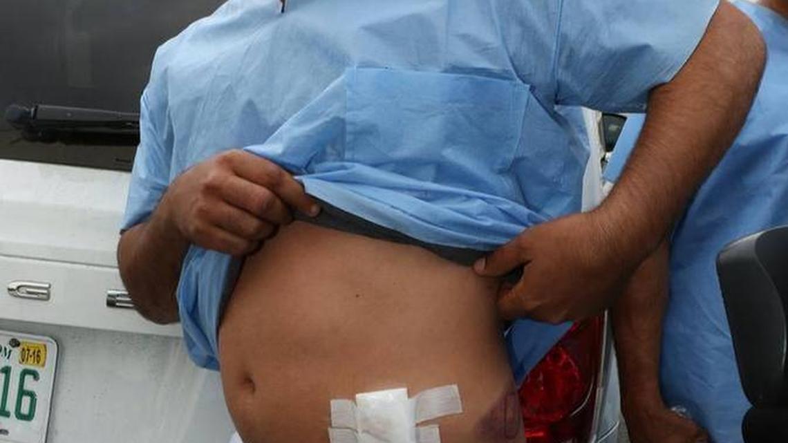 Yaser Cabrera Romero, one of the rafters who arrived from Cuba on Saturday, talks to the press on Sunday and shows the bullet wound he sustained during the crossing.