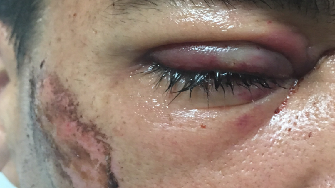 Gustavo Castano, who is being investigated by police in the disappearance of his girlfriend and daughter, lost his right eye after being shot by a police Taser, his lawyer said Monday.