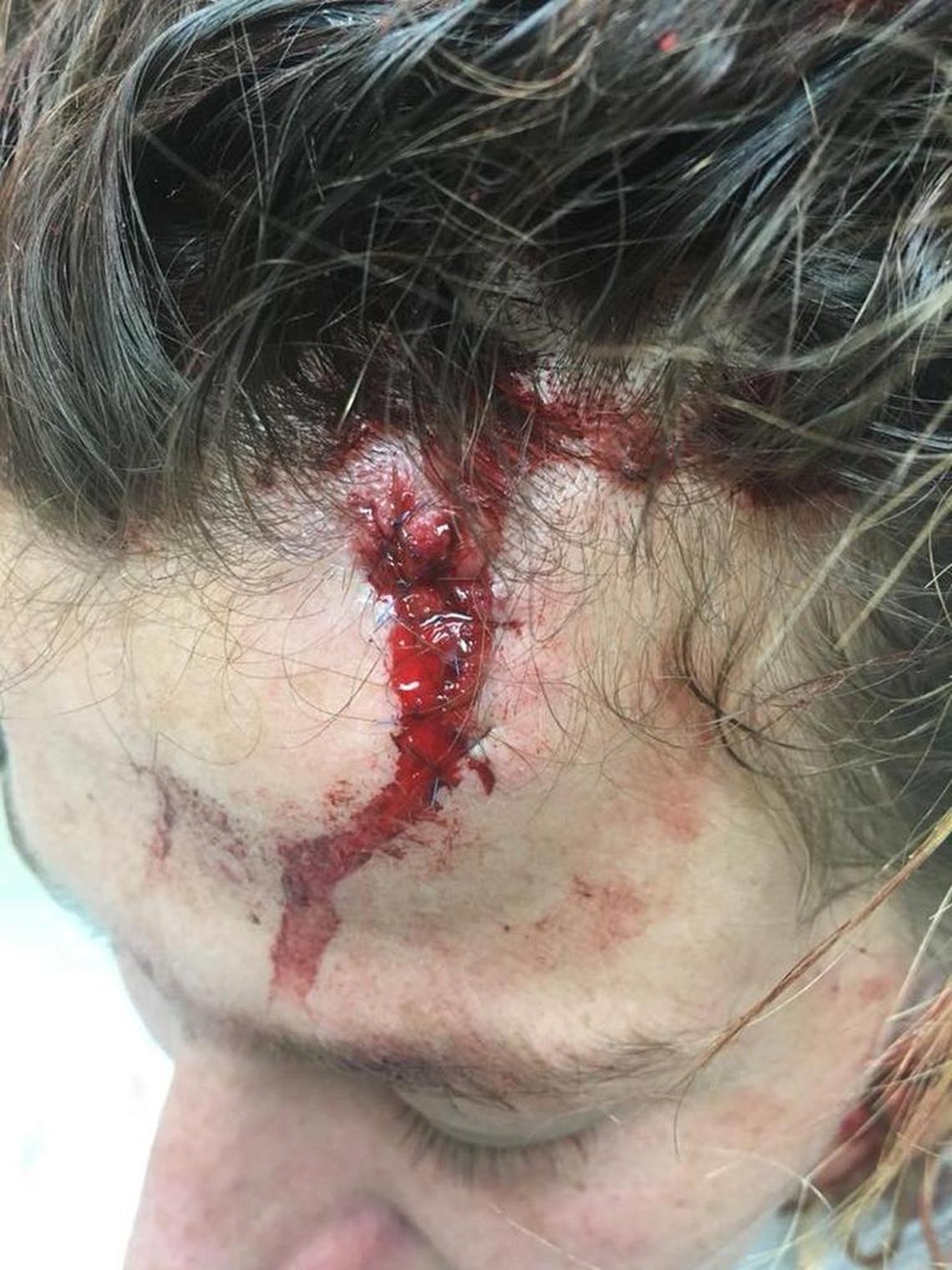Mikaela Barboza, 26, has a broken nose, seven stitches and seven stapes in her head after two women beat her with baseball bats in what she said was a road rage attack.