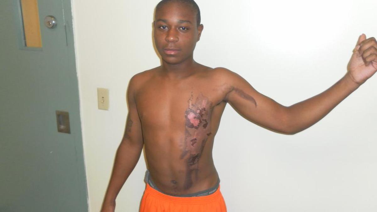 Former Miami-Dade jail inmate Joshua Wiggins shows second-degree burns he suffered after a corrections officer doused him with scalding water in August 2012.