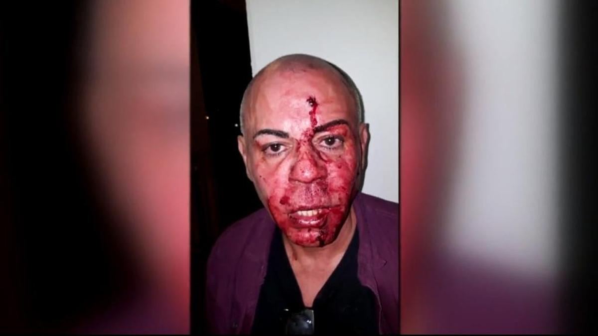 A screengrab from a WPLG Local 10 video report shows Lyft passenger Jose Gonzalez bloodied and battered in the face after he said a Lyft passenger in a shared ride from South Beach beat and kicked him when the driver said he was dropping Gonzalez off first.
