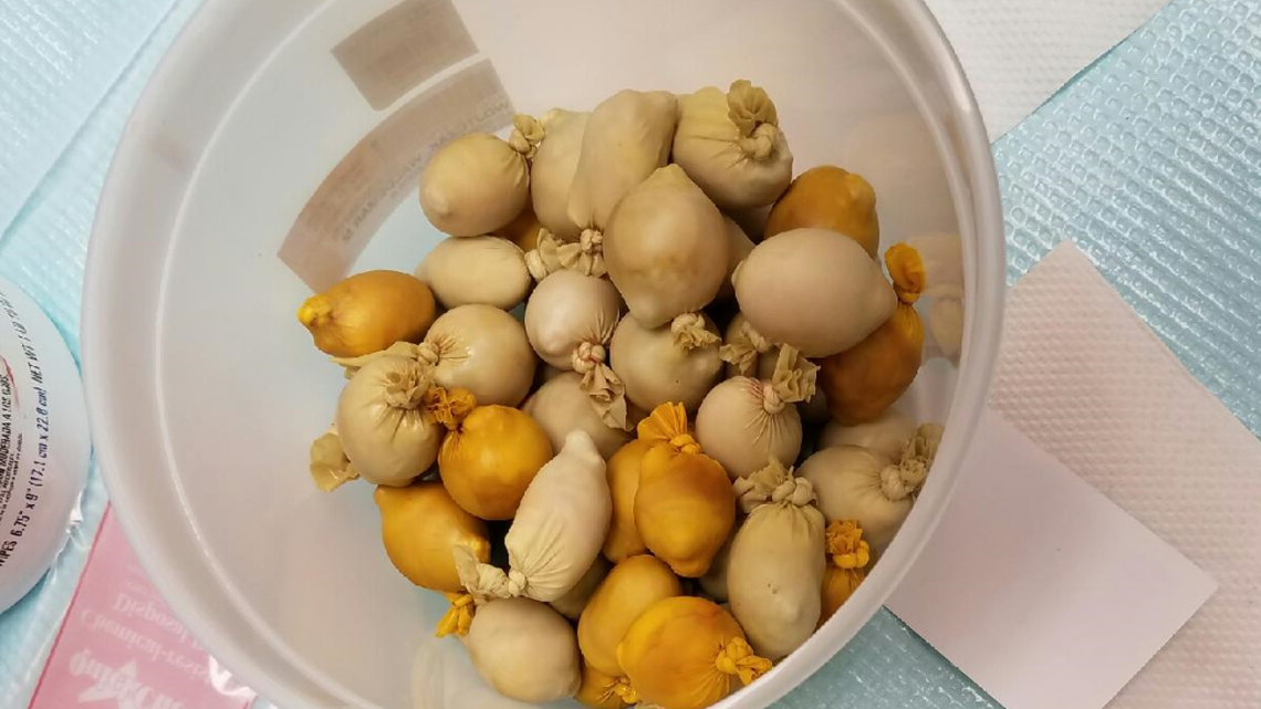 Cocaine-filled rubber pellets removed from the belly of a Polish man who collapsed at Miami International Airport.