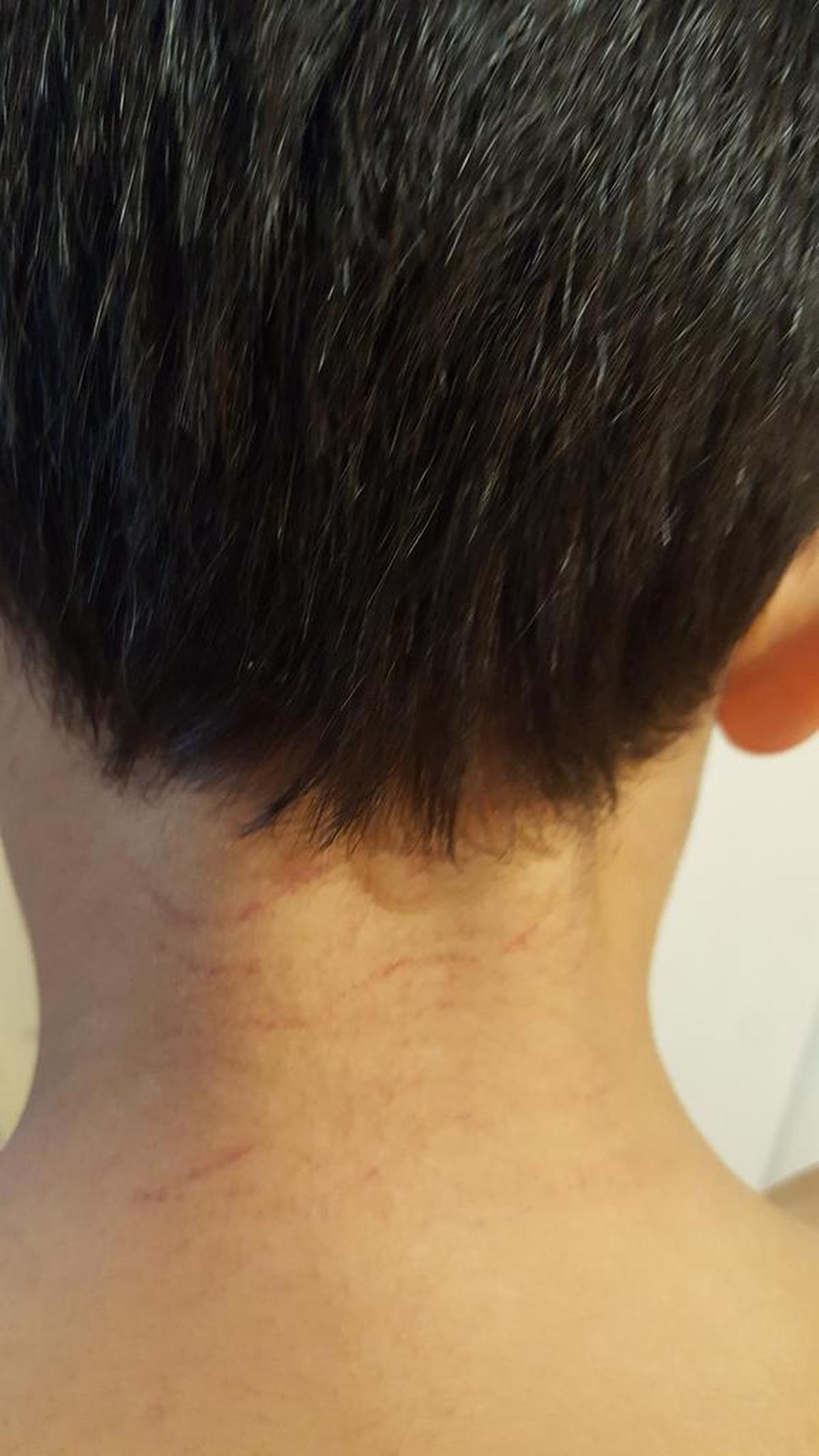 10-year-old Kevin Bowles scratched his stomach, back and chest in distress after his school tried to Baker Act him.