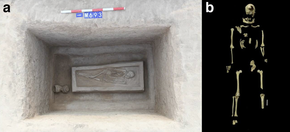 The tomb and skeleton of the man with the left leg amputation