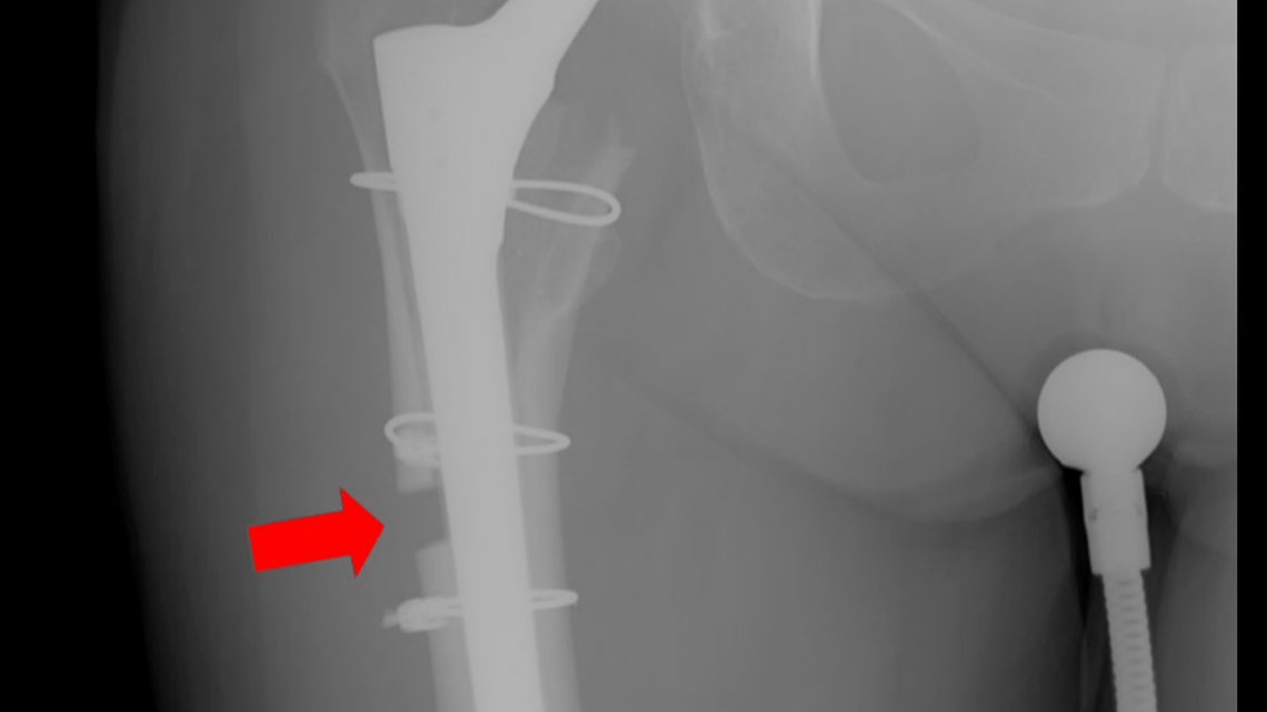 A new lawsuit filed in Maine shows x-rays from a woman’s follow-up surgeries after a hip replacement in 2019. The woman says her doctor cut away a piece of her femur and failed to close a gap of about 1 centimeter.