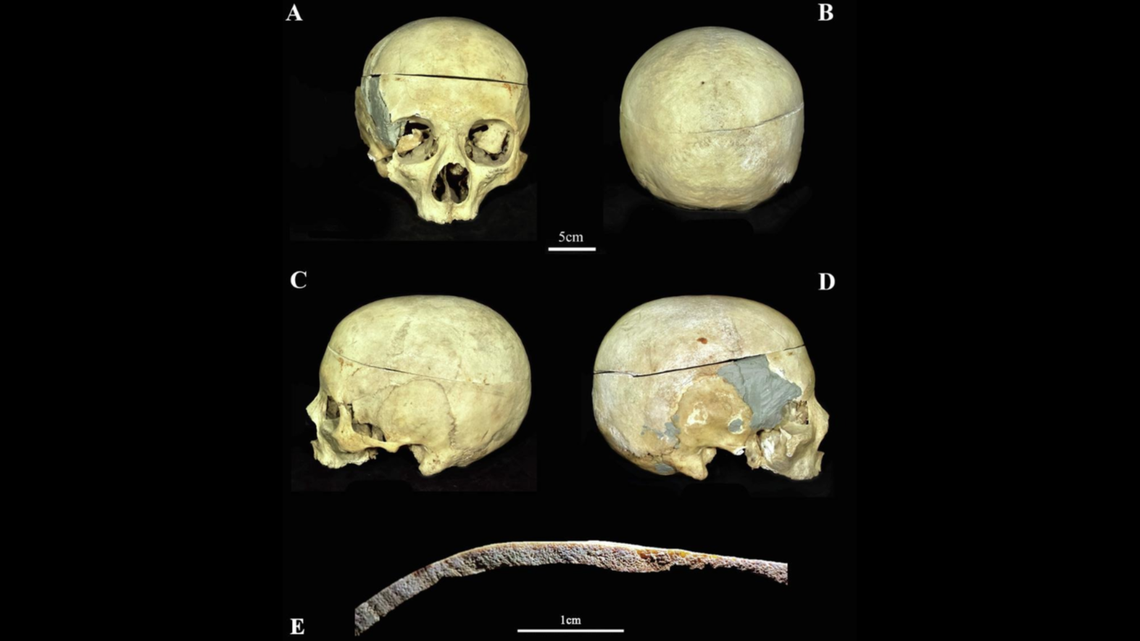 Skulls found in a centuries-old underground cemetery in Italy shed light on the medical practices of the past, according to a new study.