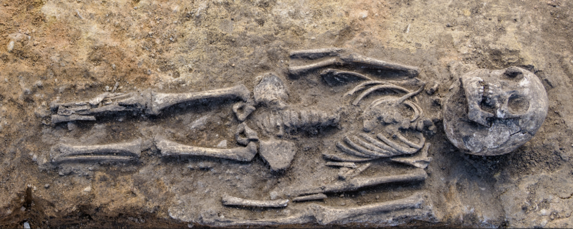 The remains of a person suspected of having hydrocephalus