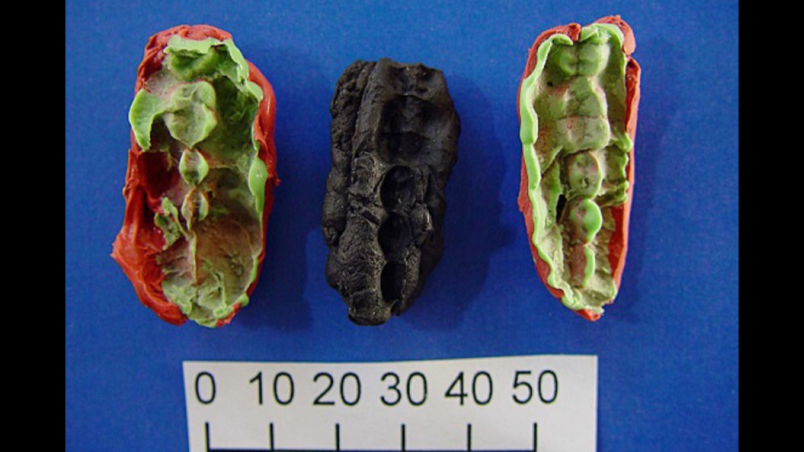 Three pieces of prehistoric chewing gum shed light on the diet and diseases of ancient Scandinavian people.