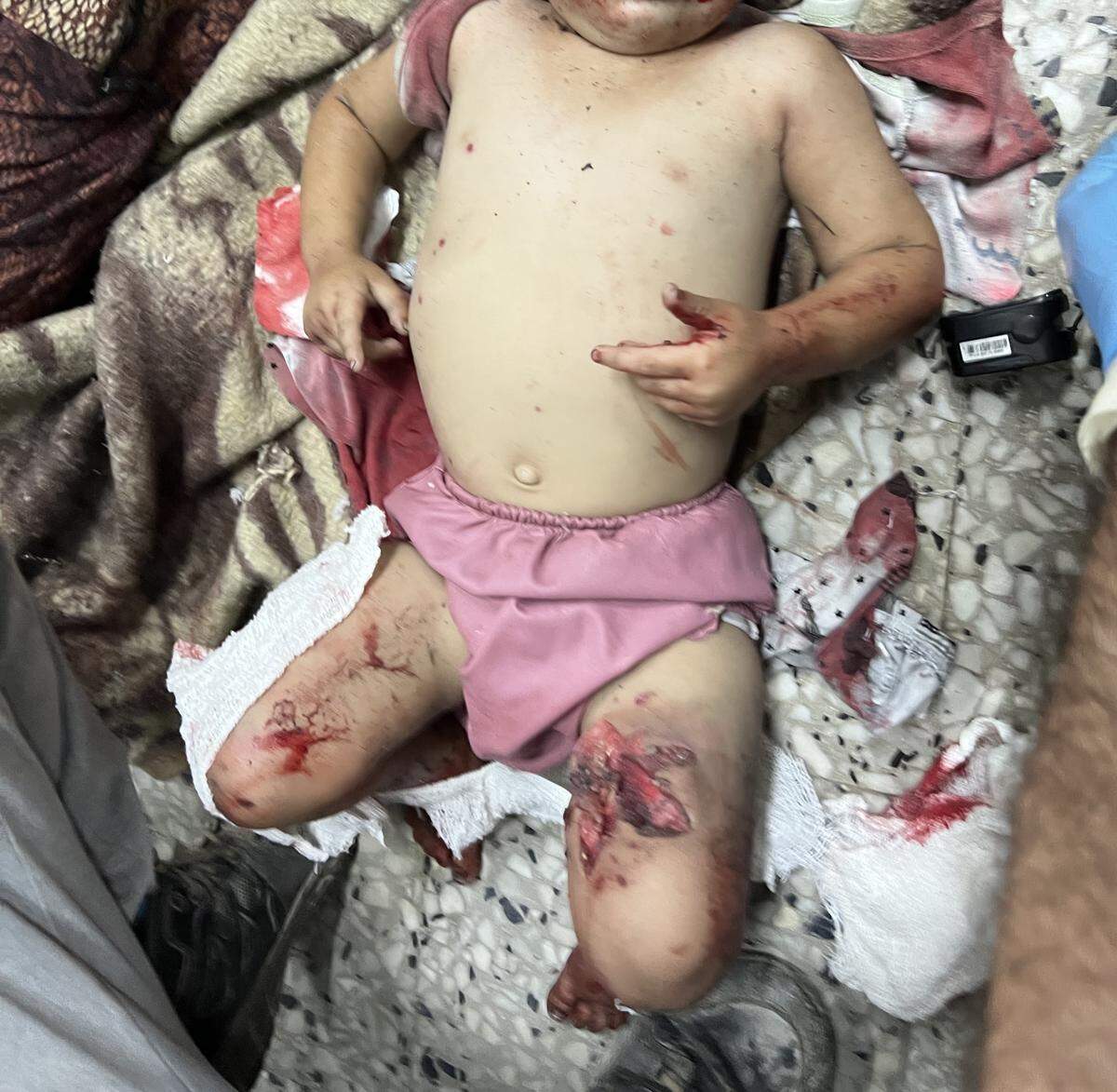 A young patient who sustained a blast injury pictured on Aug. 15 at Al-Shifa Hospital