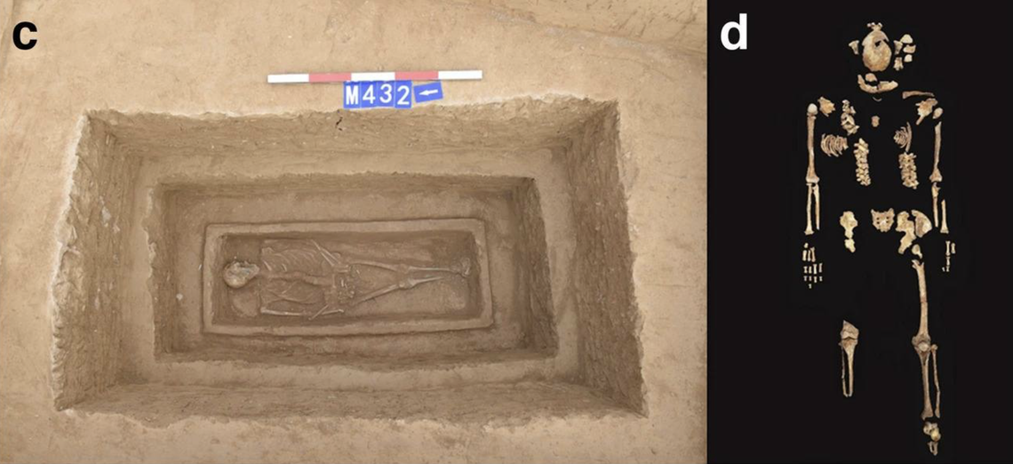 The tomb and skeleton of the man with the right leg amputation