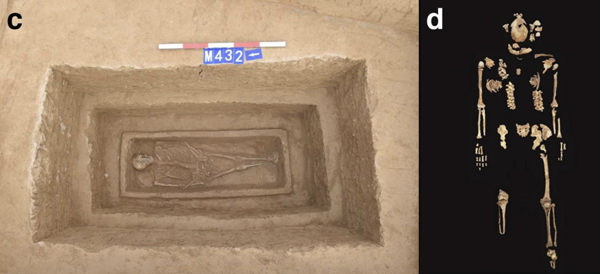 The tomb and skeleton of the man with the right leg amputation
