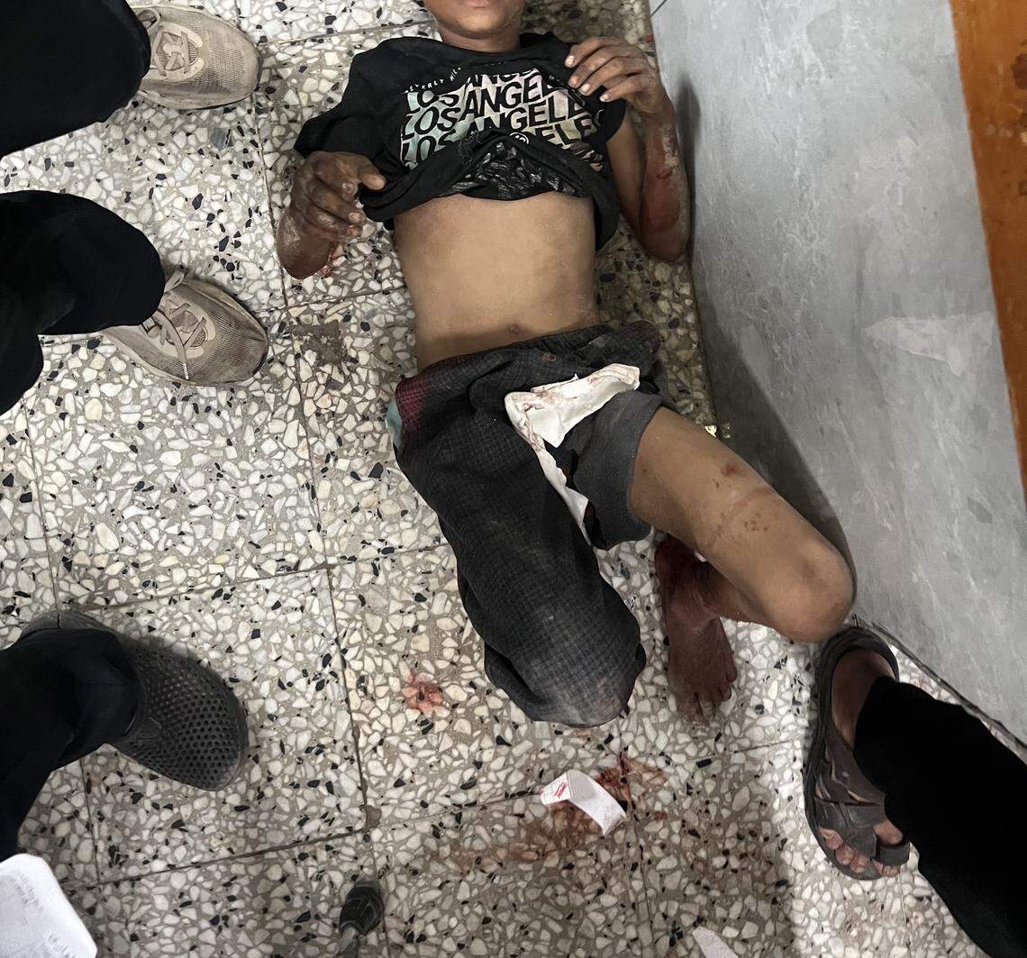 This patient, pictured on Aug. 15 at Al-Shifa Hospital, sustained gunshot wounds to his leg. “He went to the aid distribution site for food,” Ali said. “He said he went because both his parents are disabled from blast injuries and they are all starving.”
