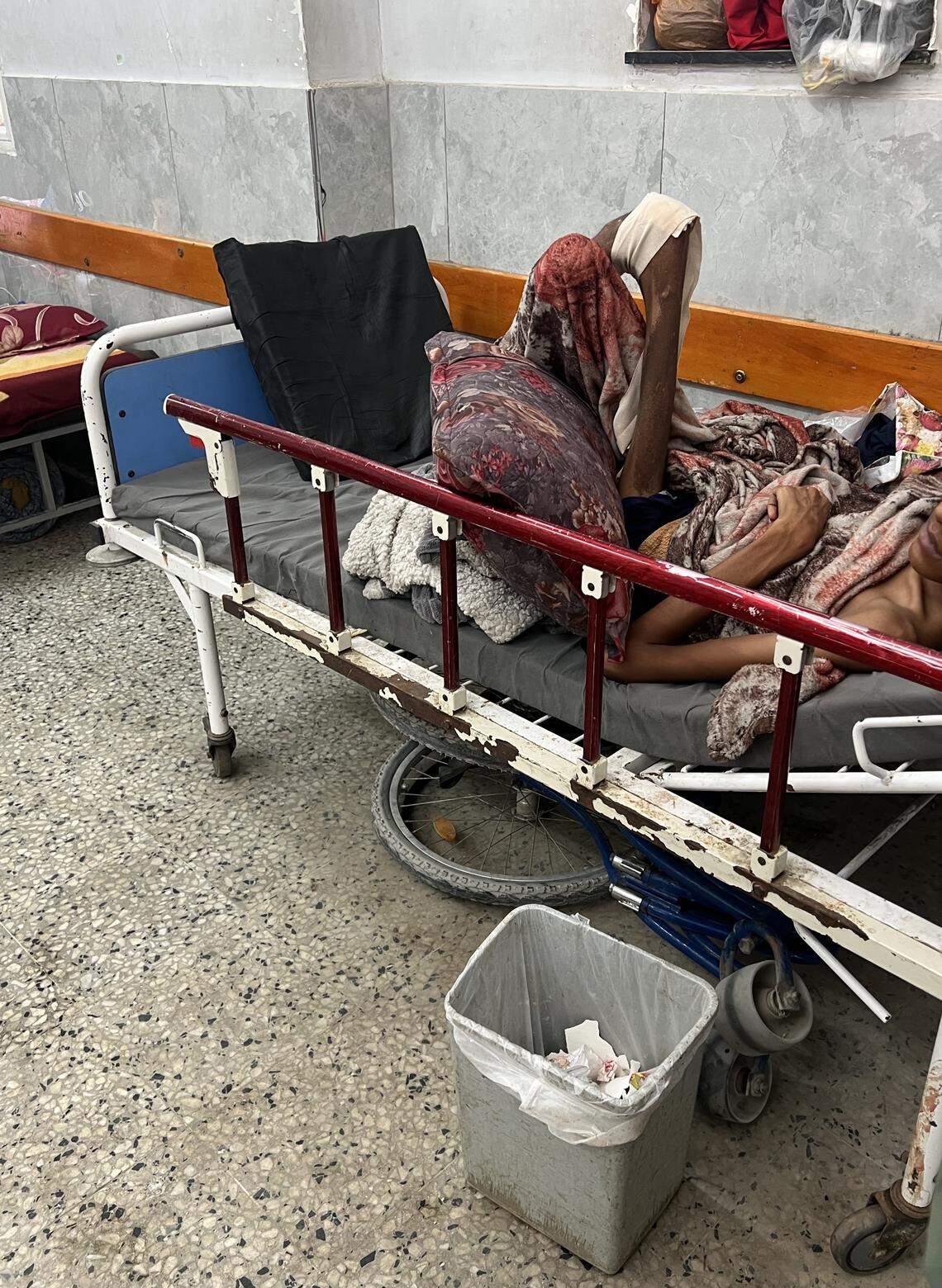 A patient with malnutrition on Aug. 9 at Al-Shifa Hospital