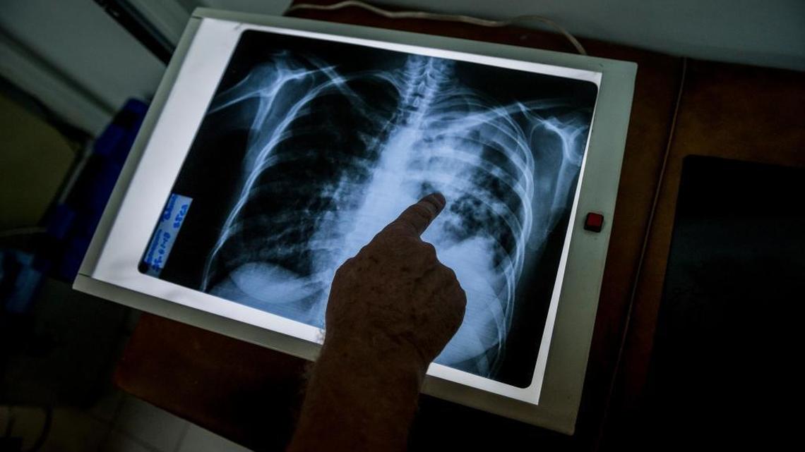 A measles outbreak in ailing Venezuela is threatening Colombia and Brazil