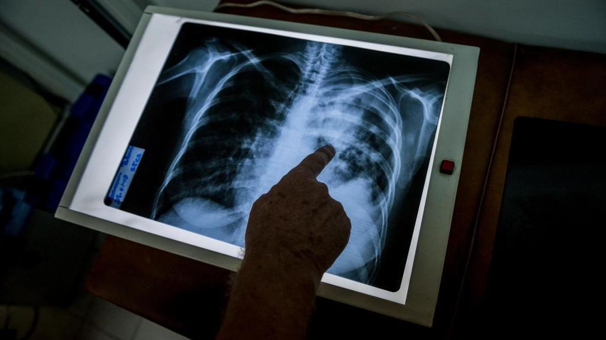 A measles outbreak in ailing Venezuela is threatening Colombia and Brazil