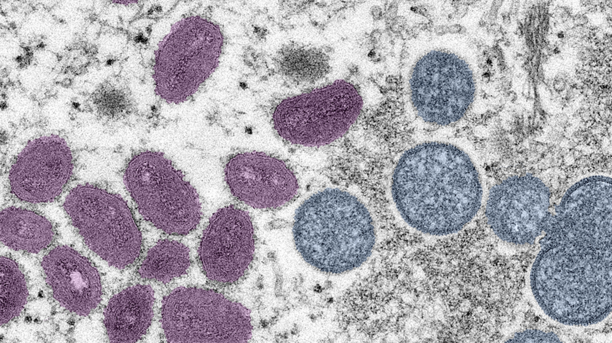 The World Health Organization has renamed monkeypox as mpox, citing concerns the original name of the decades-old animal disease could be construed as discriminatory and racist.