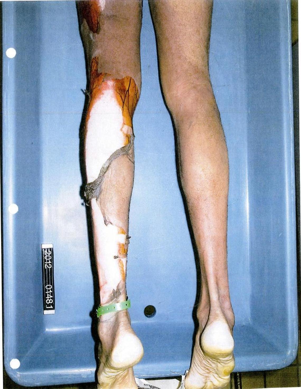 Autopsy photo of Darren Rainey’s legs