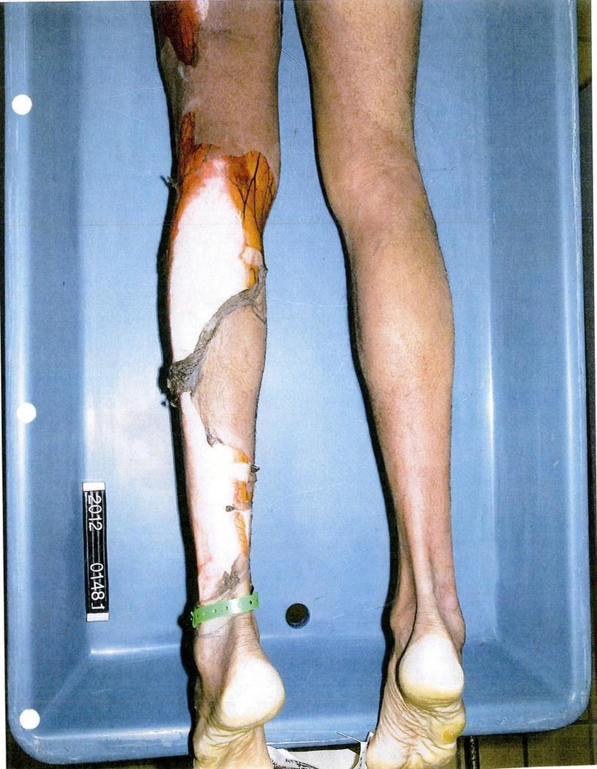 Autopsy photo of Darren Rainey’s legs