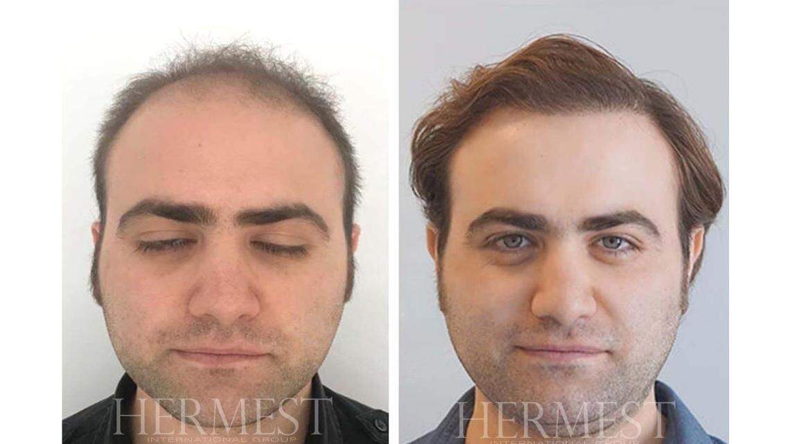 The Truth About Turkey’s Best Hair Transplant Clinic: Floridians’ Choice
