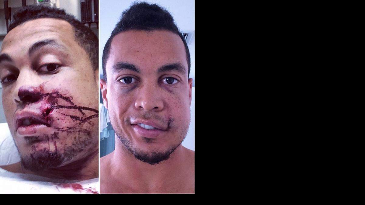 
Miami Marlins slugger Giancarlo Stanton shared this before and after photo Tuesday, Sept. 16, 2014 showing his recovery after getting hit in the face by a pitch Thursday, Sept. 11, 2014.
